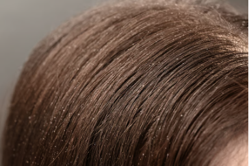 Flaky scalp from minoxidil irritation
